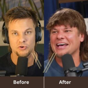 Theo Von Hair Transplant: Before and After Result