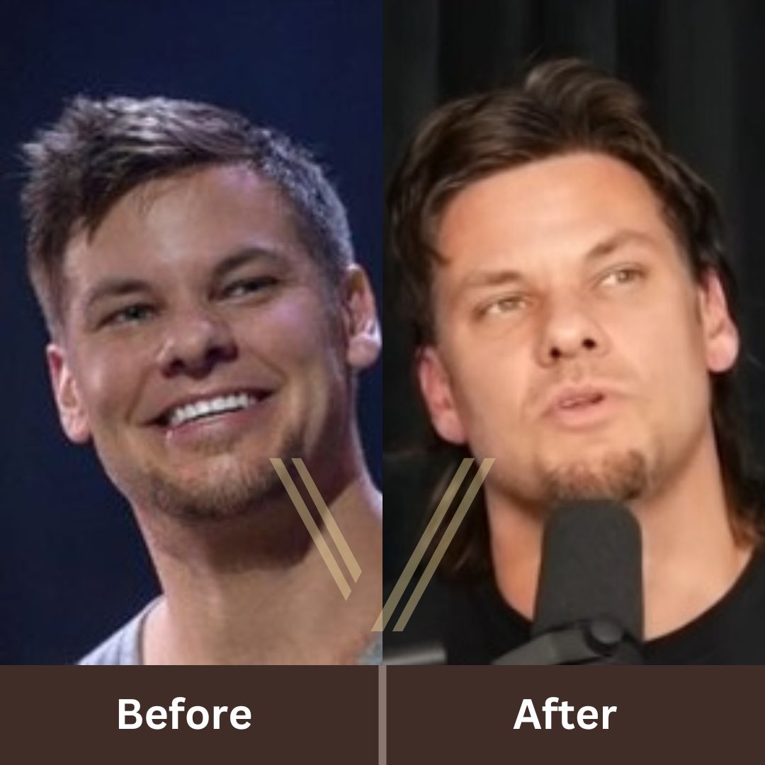 Theo Von Hair Transplant: Before and After Result