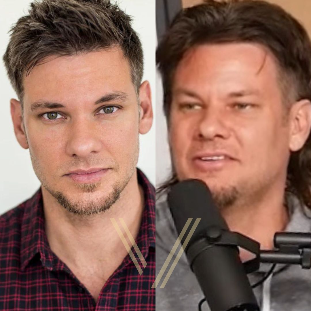 Theo Von Hair Transplant Before and After Result