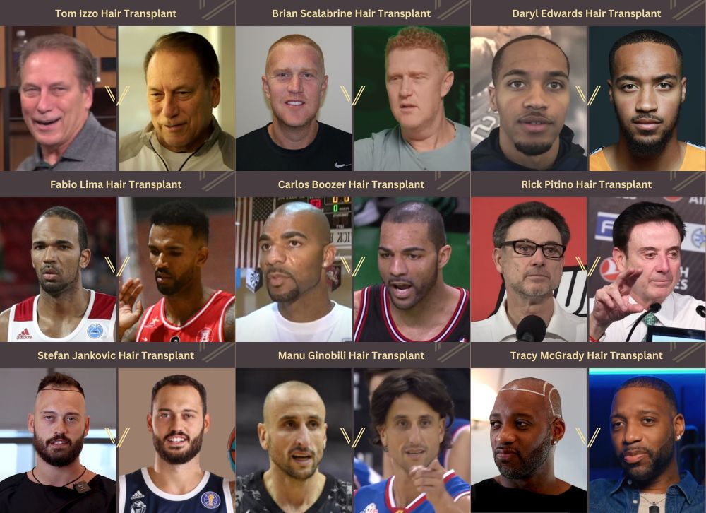 basketball players with hair transplants