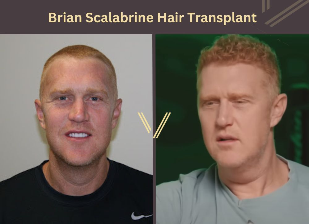 brian scalabrine hair transplant