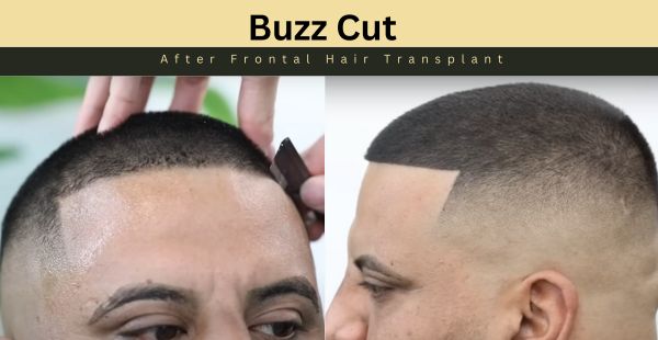 Buzz Cut After Frontal Hair Transplant