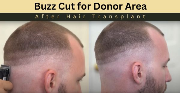 Buzz Cut for Donor Area After Hair Transplant