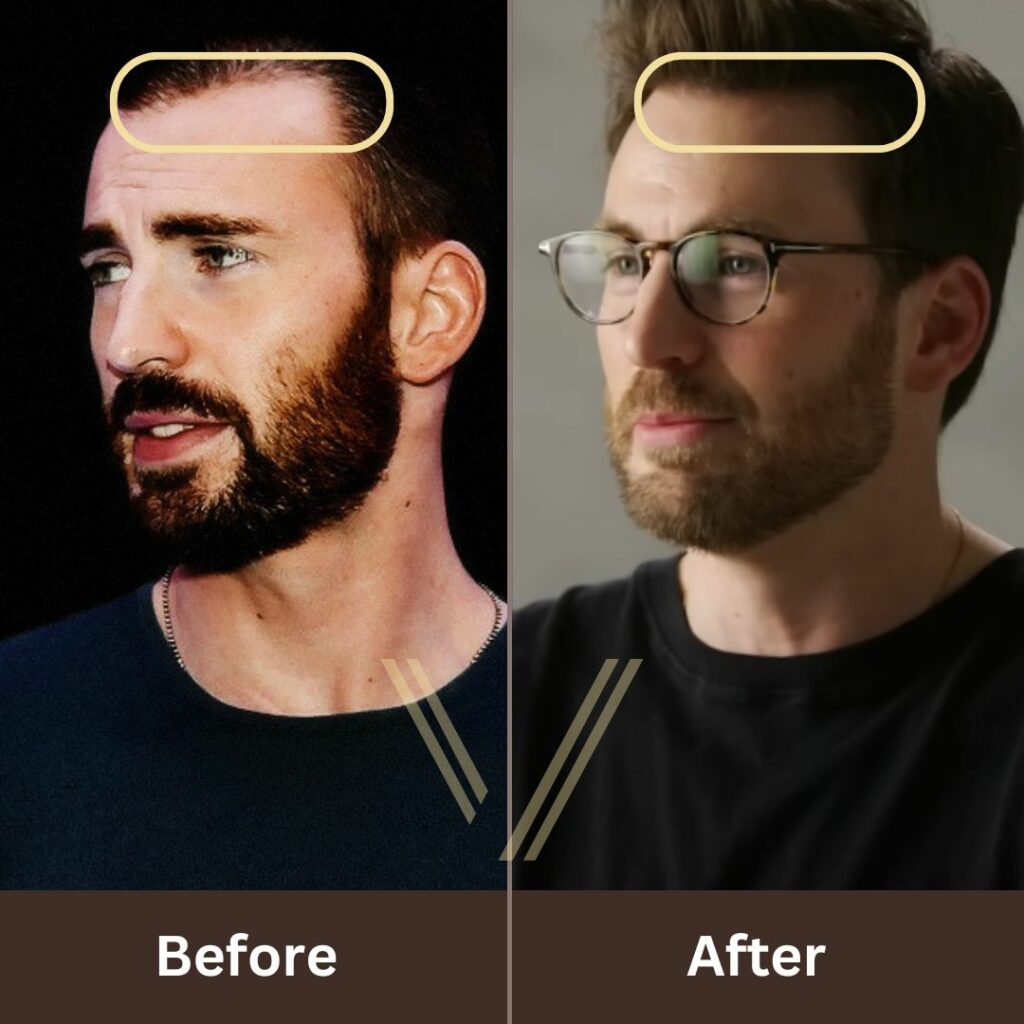 Chris Evans Hair Transplant's: Before and After Result