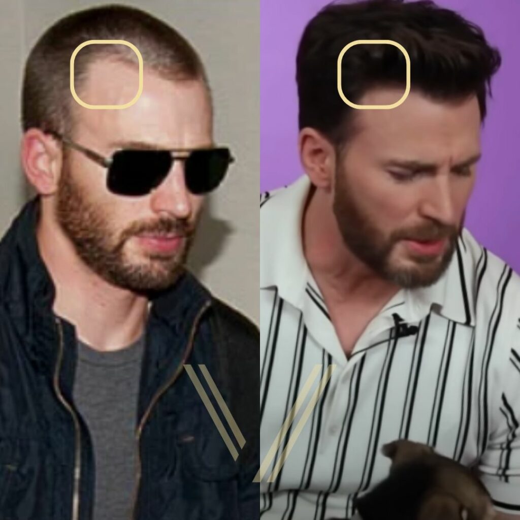 Chris Evans Hair Transplant's: Before and After Result