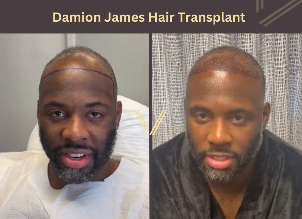 damion james hair transplant