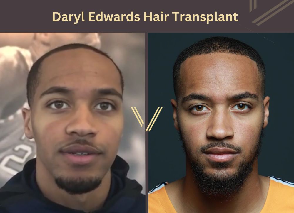 daryl edwards hair transplant