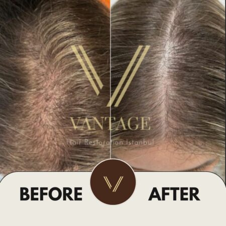 diffuse thinning hair transplant before and after