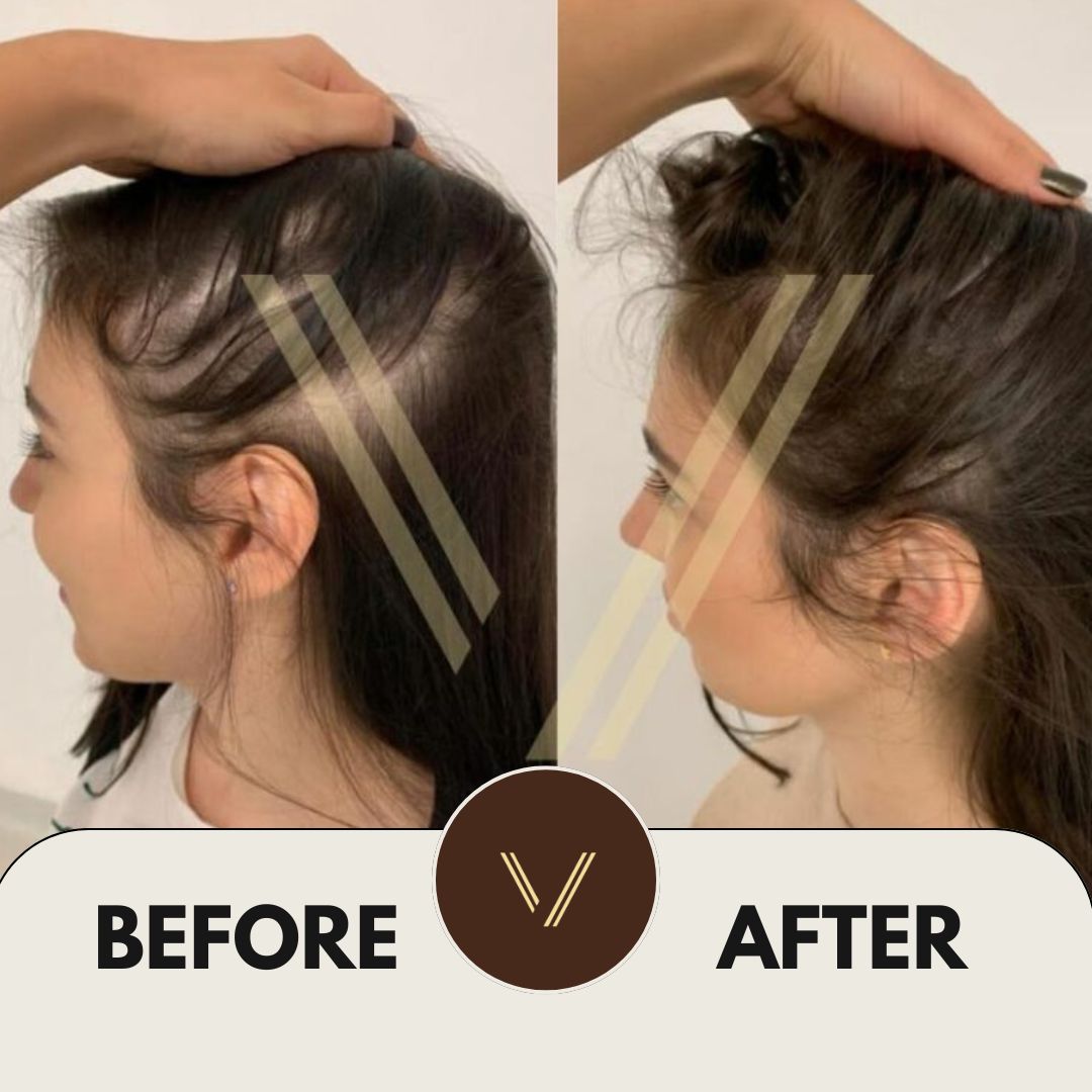 Diffuse Thinning Hair Loss: Symptoms, Causes and Treatments