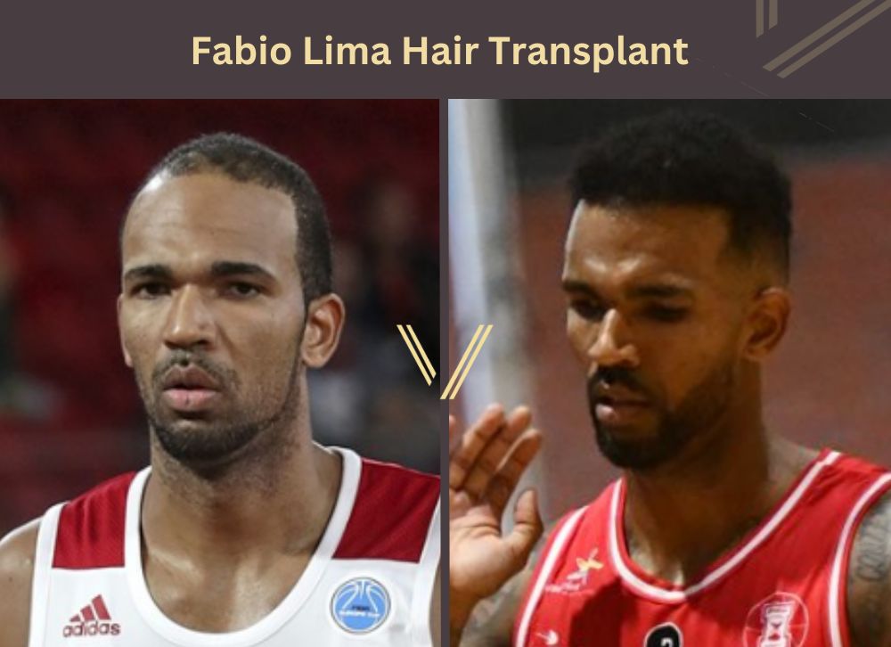 fabio lima hair transplant