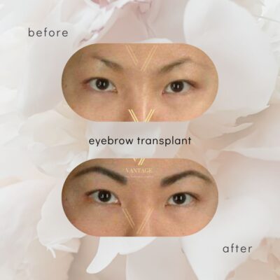 female eyebrow transplant before after