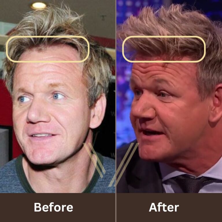 Gordon Ramsay's Hair Transplant: Before and After Result