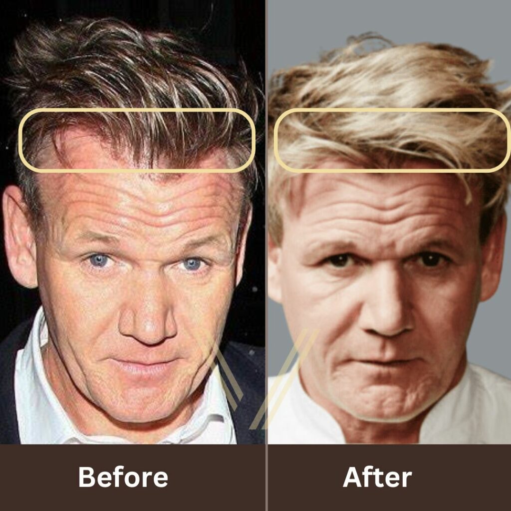 Gordon Ramsay's Hair Transplant: Before and After Result