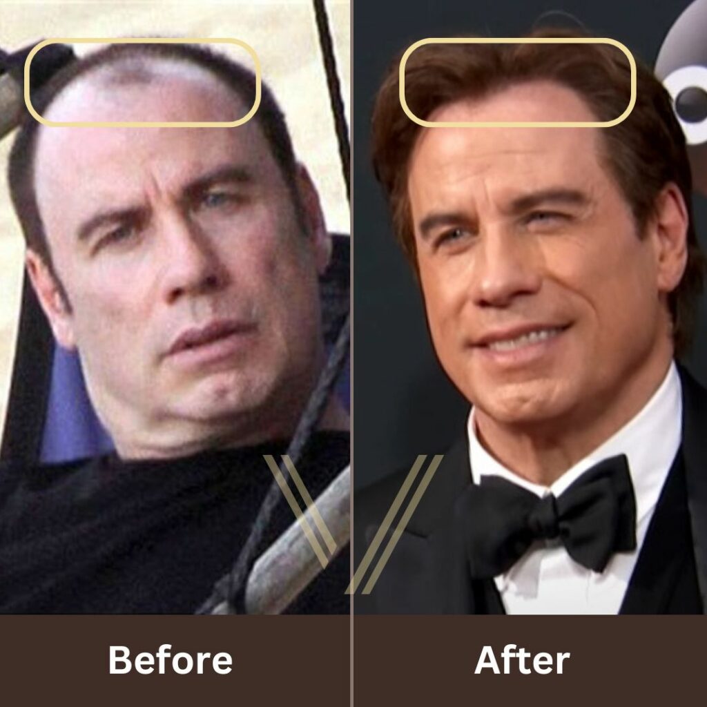 John Travolta’s Transformative Hair Transplant Journey