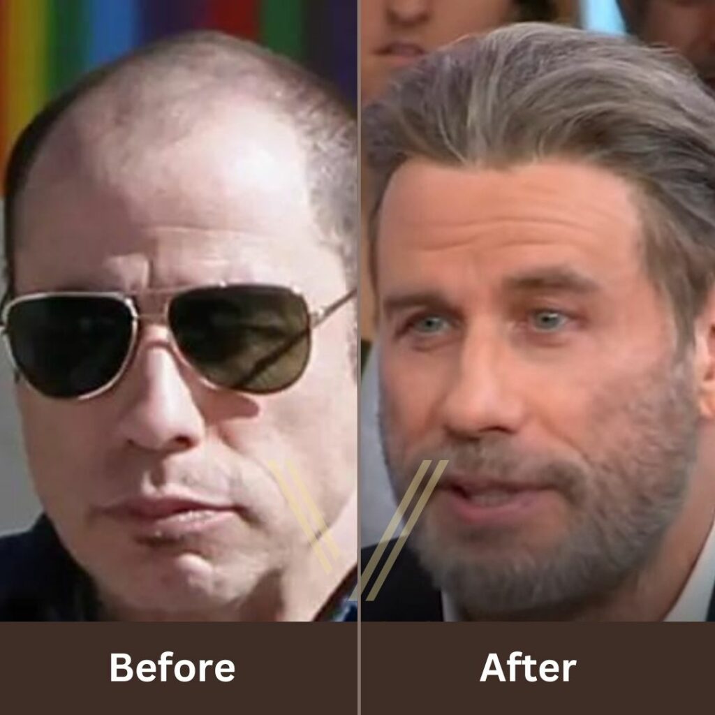 John Travolta's Hair Transplant: Before and After Result