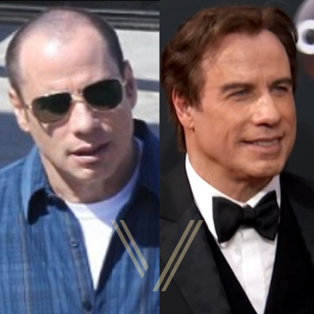 John Travolta Hair Transplant: Before and After Result