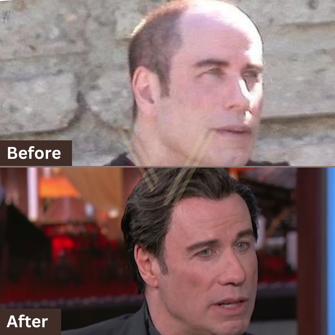 John Travolta Hair Transplant: Before and After Result