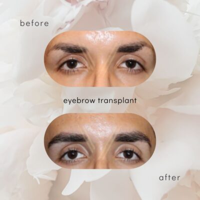 male eyebrow transplant before after