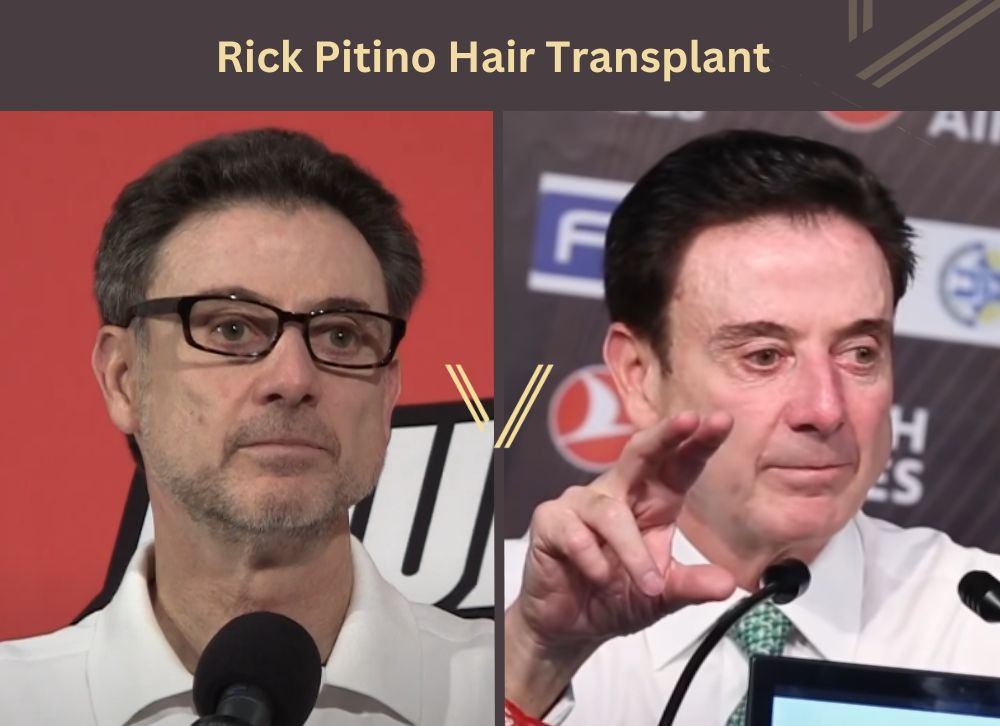rick pitino hair transplant