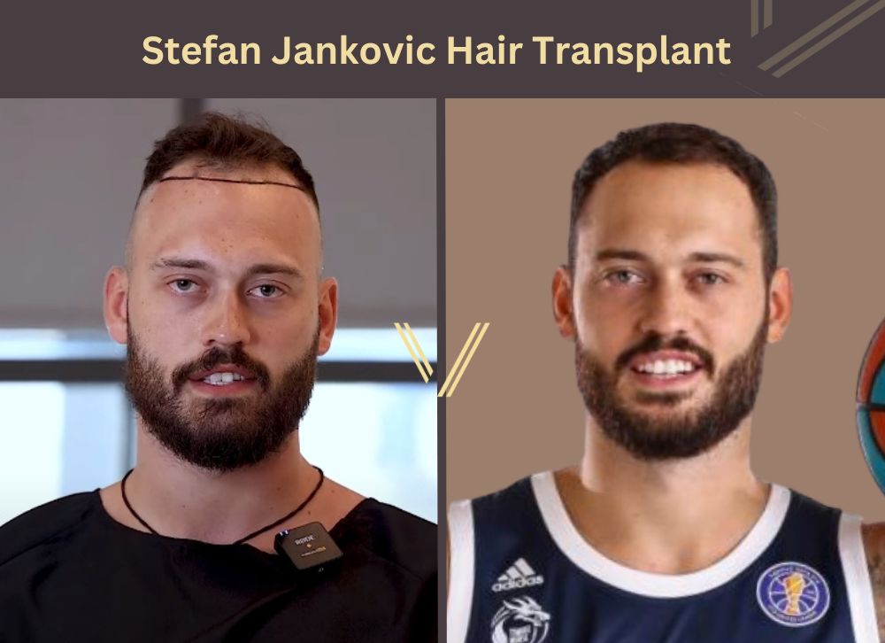stefan jankovic hair transplant