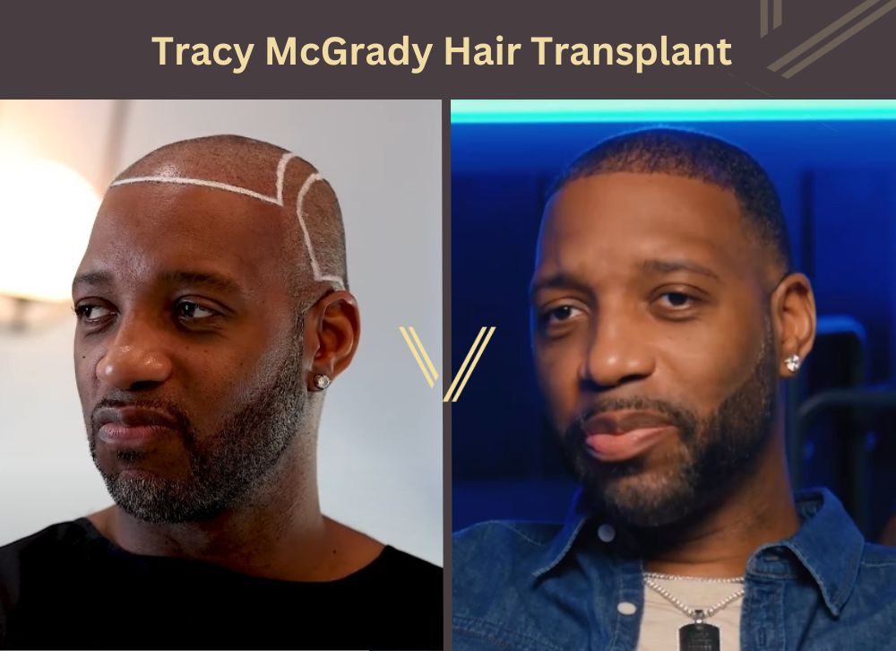 tracy mcgrady hair transplant