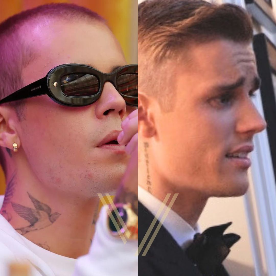 Justin Bieber Hair Transplant Before and After Result