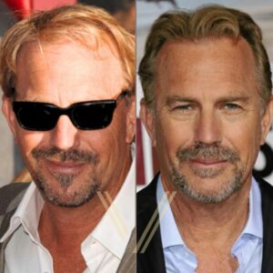 Kevin Costner's Hair Transplant: Before and After Result