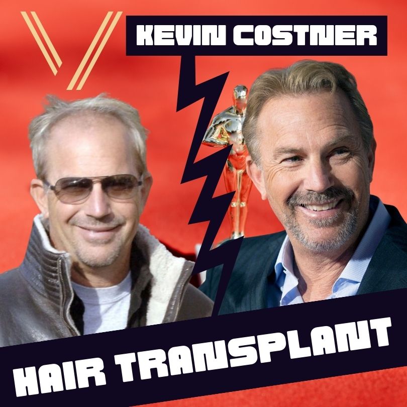 Kevin Costner's Hair Transplant: Before And After Result