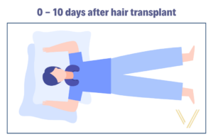 sleep position 0-10 days after hair transplant