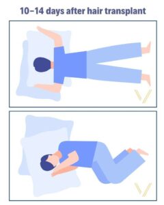sleep position 10-14 days after hair transplant