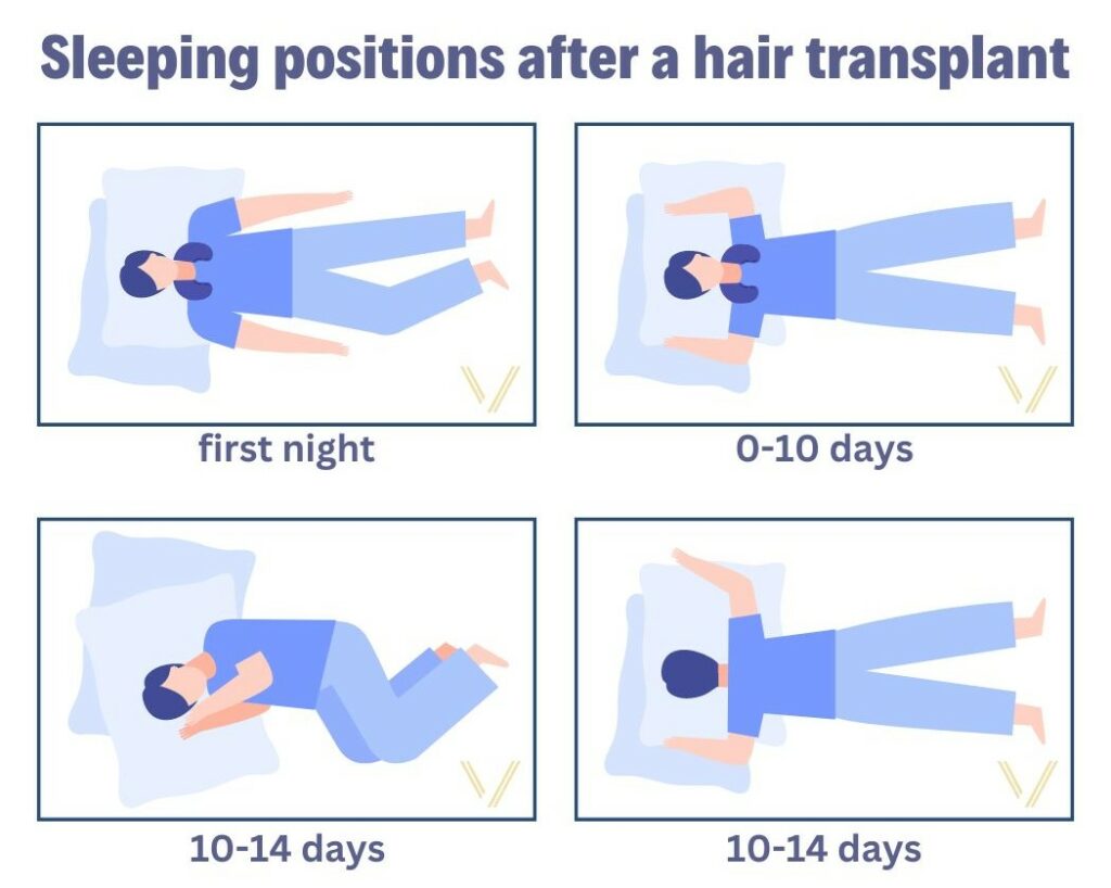 sleep position after hair transplant