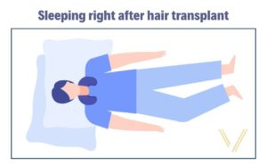 sleep position right after hair transplant 