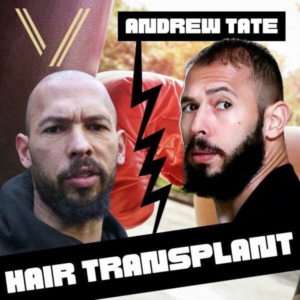 Andrew Tate Hair Transplant: Before and After Result