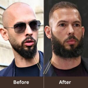 Andrew Tate Hair Transplant: Before and After Result