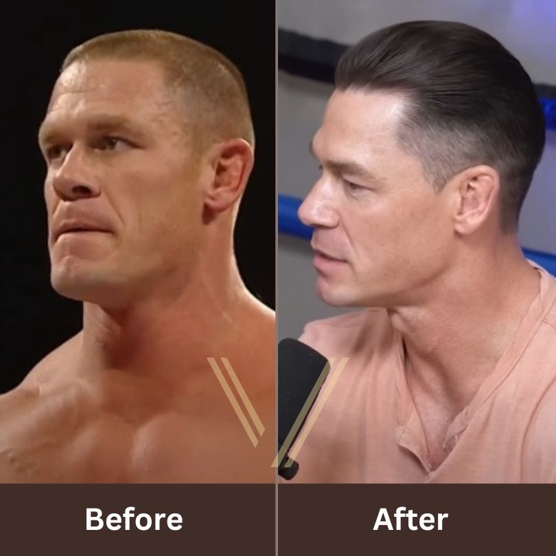 John Cena Hair Transplant: Before and After Result