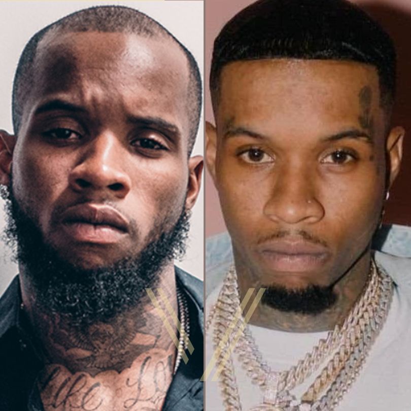 tory-lanez-hair-transplant-before-and-after-result