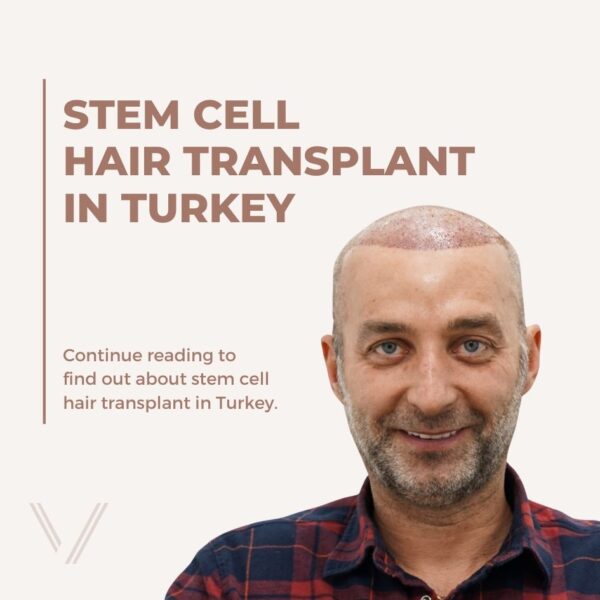 Stem Cell Hair Transplant in Turkey
