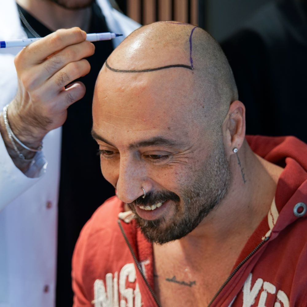 stem cell hair transplant patient