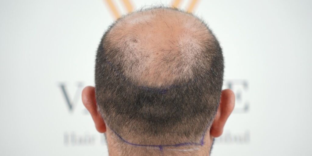 how crown balding looks like