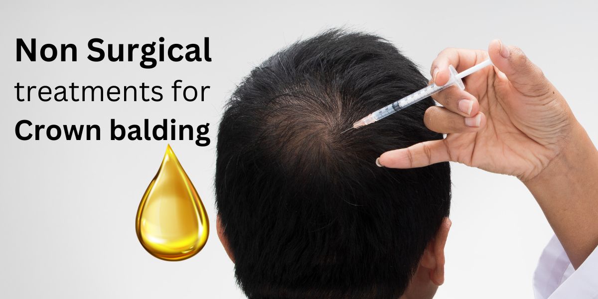 non surgical treatments crown balding