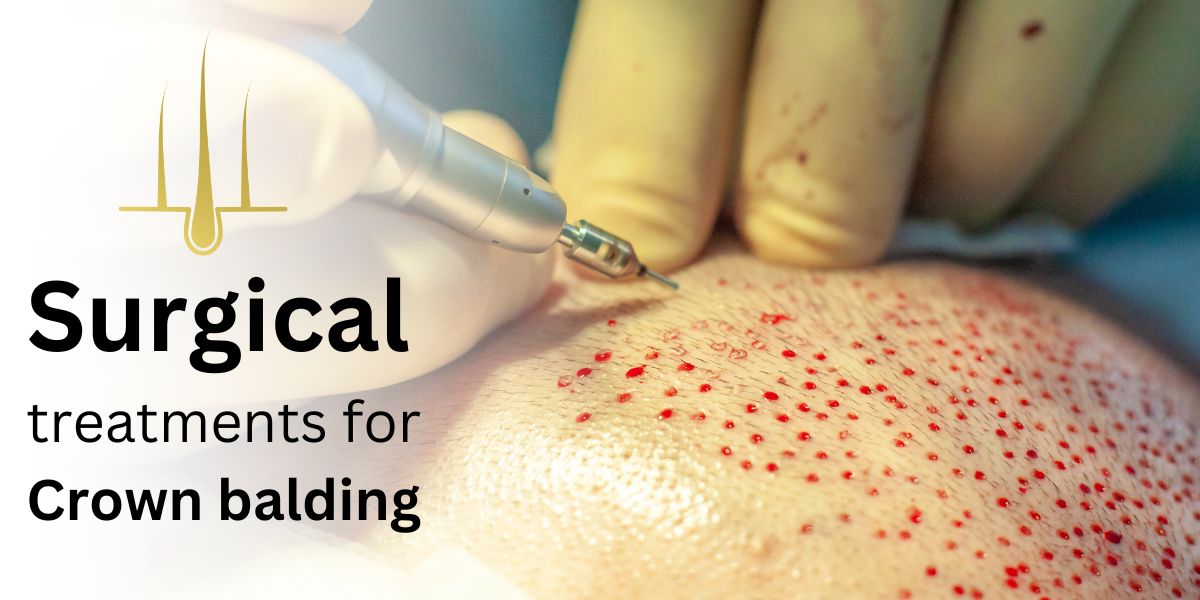 Surgical treatments for Crown balding