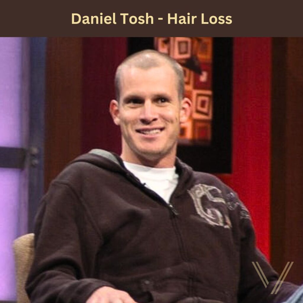 Daniel Tosh's Hair Loss