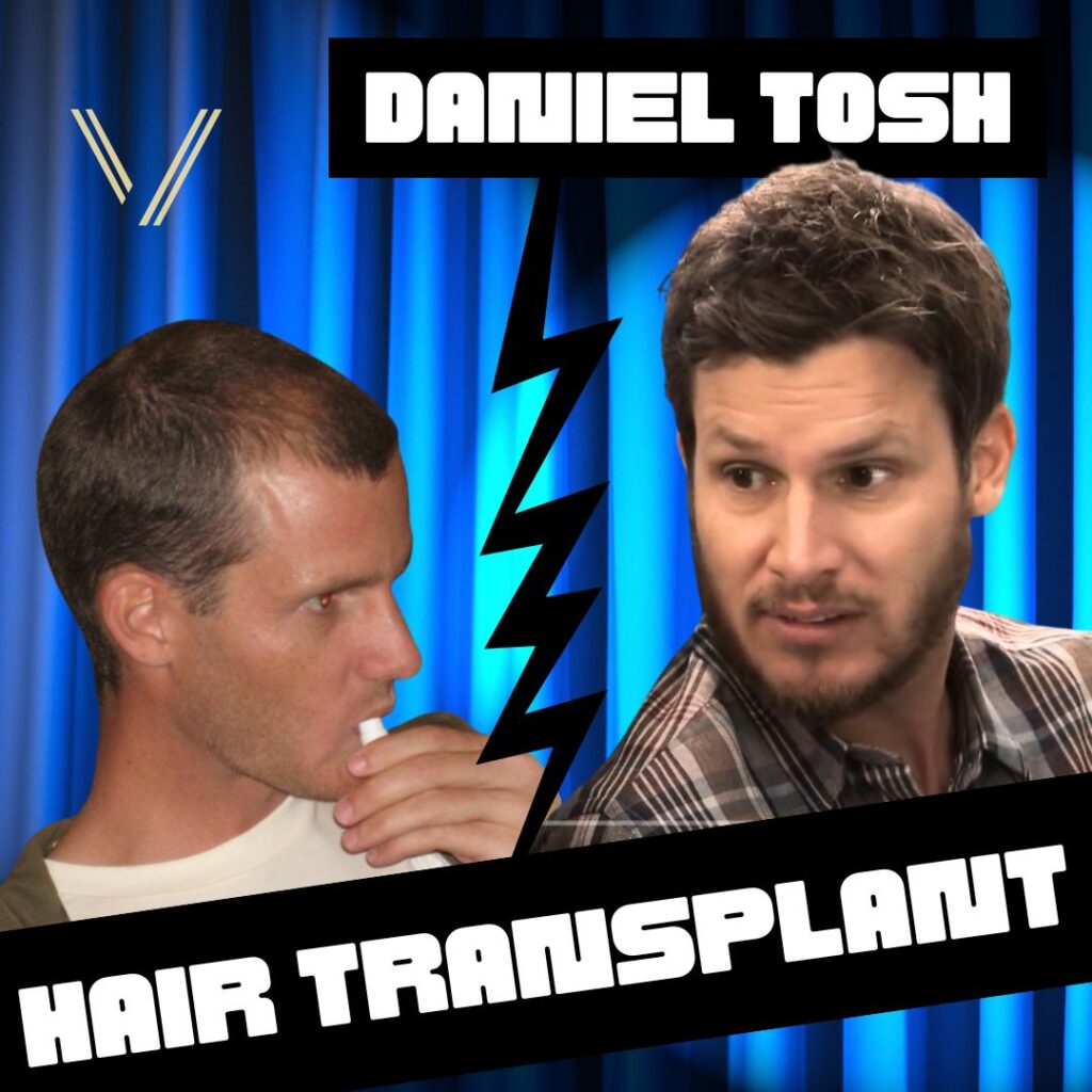 Daniel Tosh hair transplant