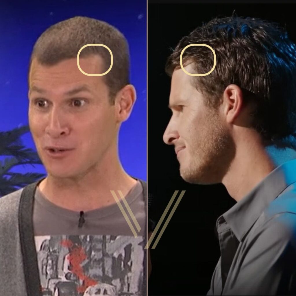 Daniel tosh hair transplant before after