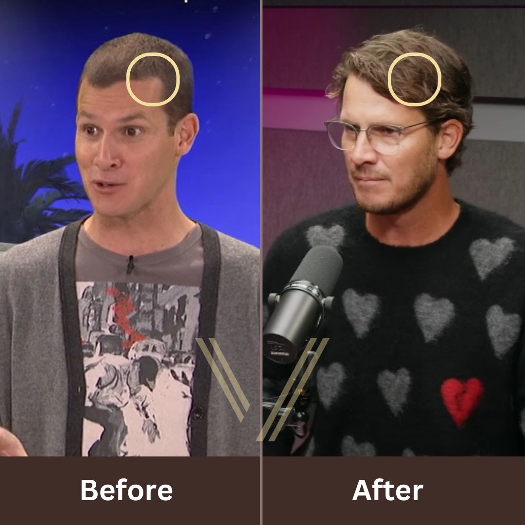 Daniel Tosh Hair Transplant