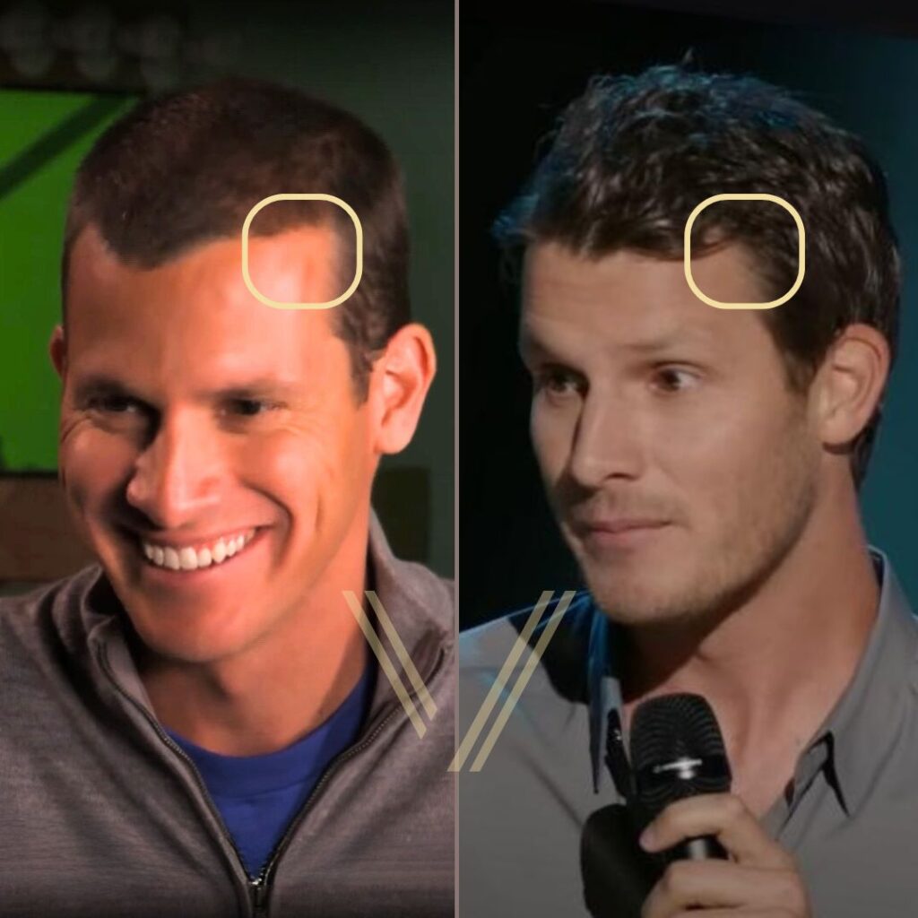 daniel tosh hair transplant before after result