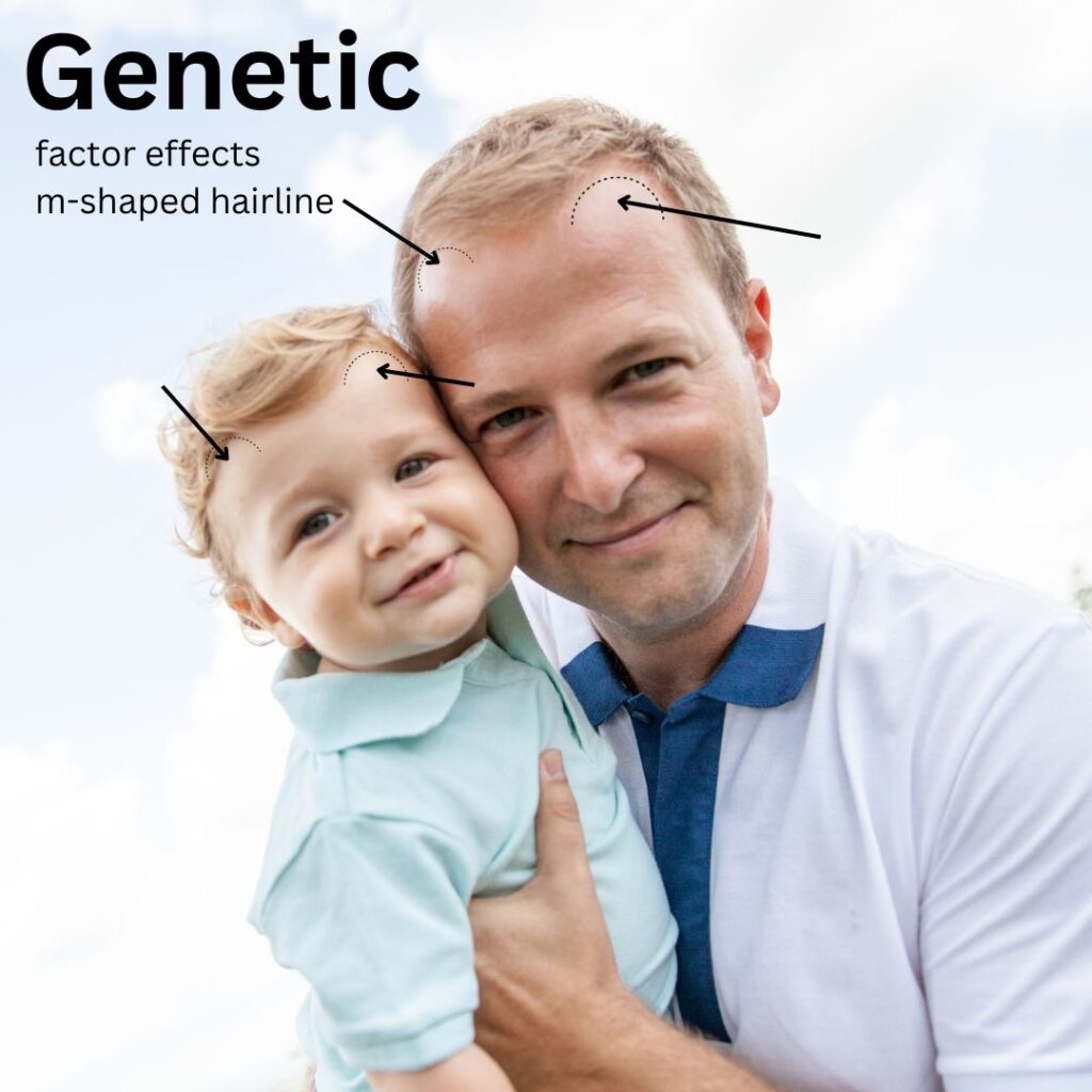 Genetic factor effects m-shaped hairline