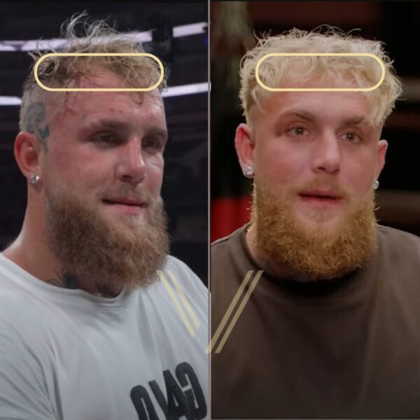 jake paul hair transplant before and after result