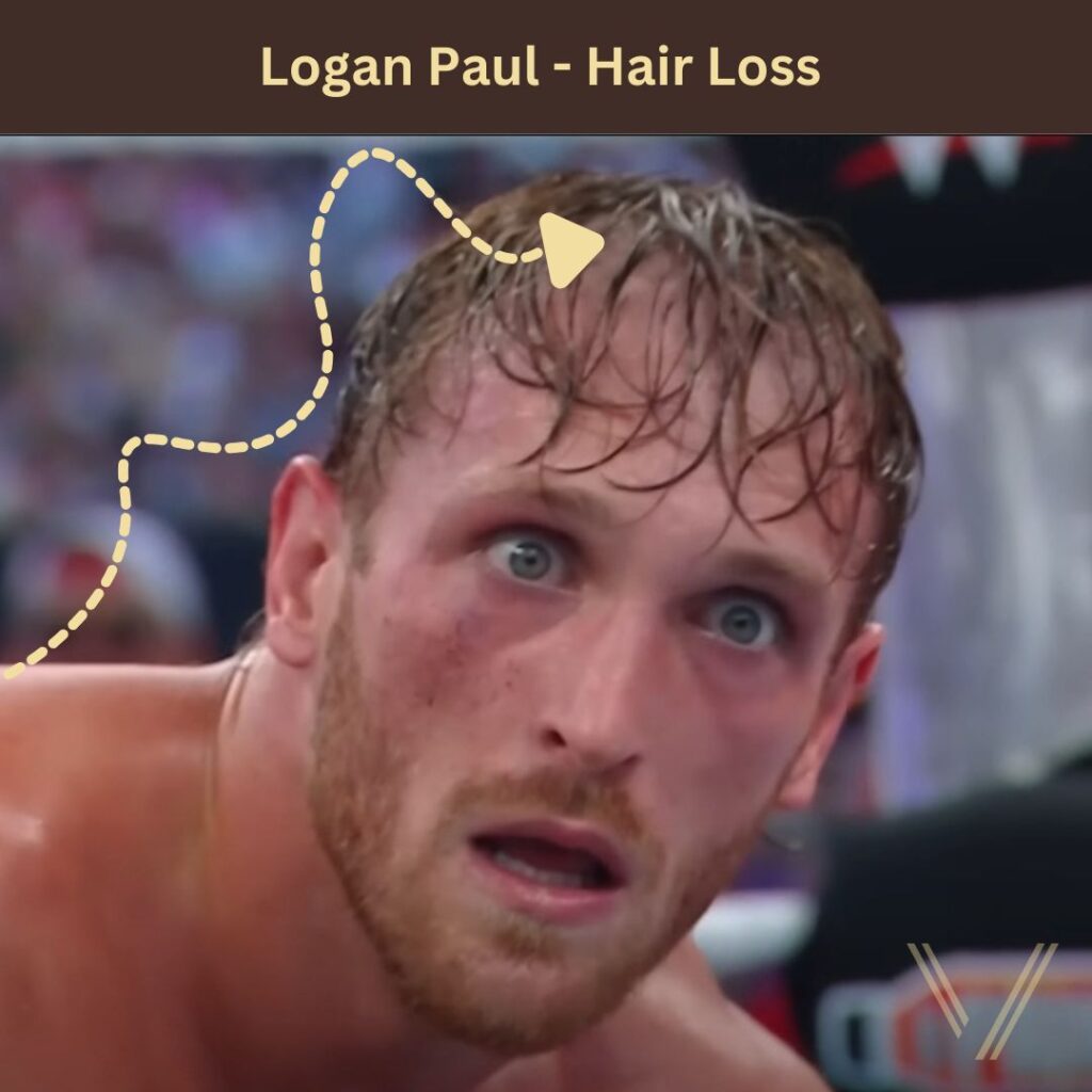 Logan Paul’s Battle with Hair Loss