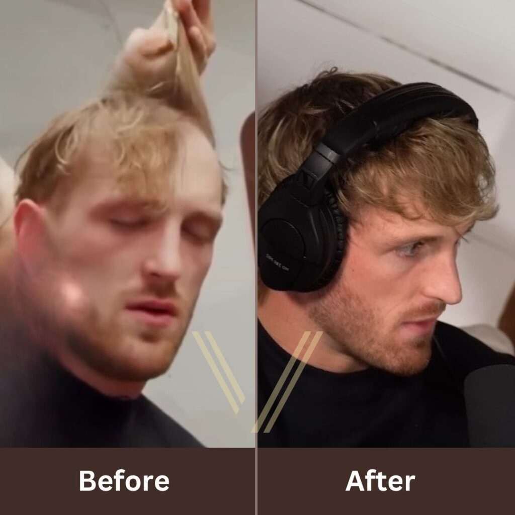 logan paul hair transplant